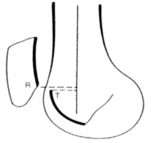 Incidence de bernageau diagnostique des douleurs de la rotule