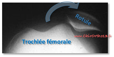 Radiographie d'une luxation de la rotule