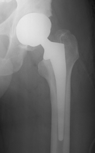 Prthèse totale de Hanche et arthrose : hanche gauche