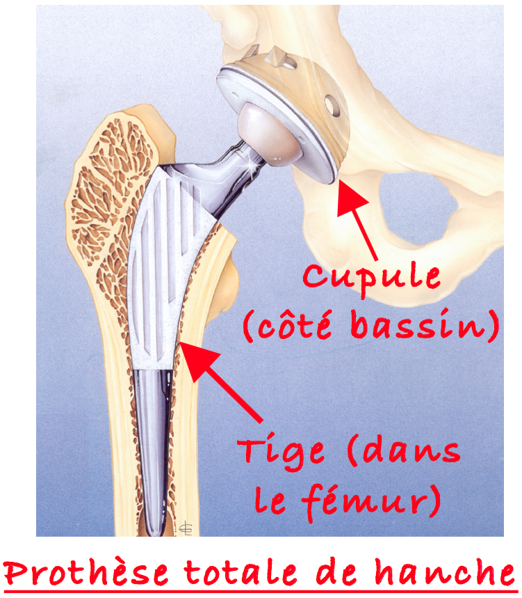 Prothèse totale de Hanche : Tige et Cupule