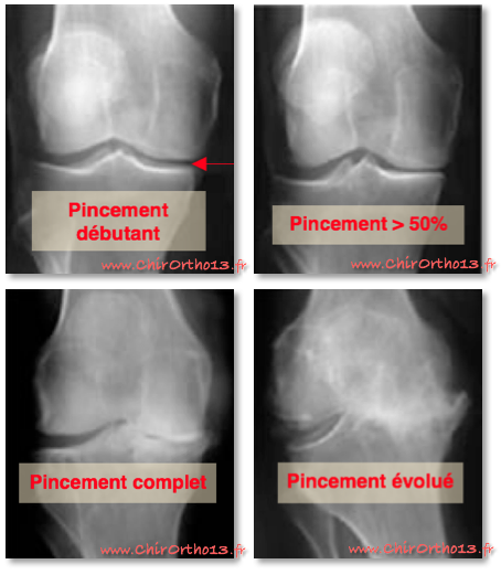 Stadartros arthrose du genou