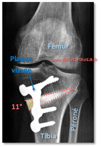 Telemfin2