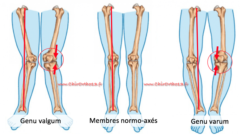 Quand Et Pourquoi Réaliser Une Ostéotomie Tibiale De Valgisation Otv