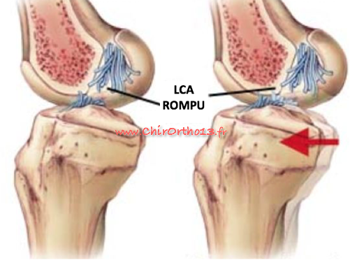 Rupture du ligament croisé antérieur et reconstruction en chirurgie ambulatoire DT4