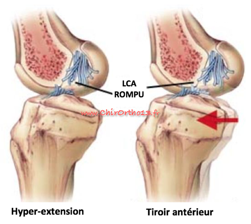 Rupture du ligament croisé antérieur et reconstruction en chirurgie ambulatoire DT4