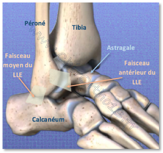 Séquelles des entorses de cheville et autres douleurs de l'arrière ...