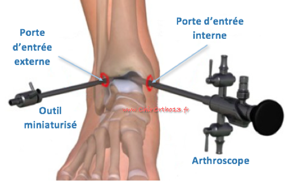 Arthrochevil3L