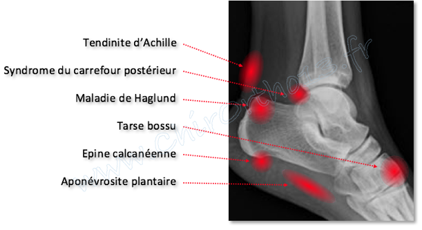 Séquelles des entorses de cheville et autres douleurs de l'arrière ...