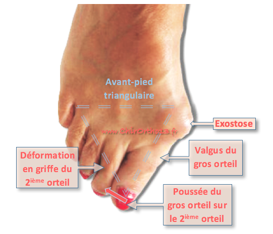 Quel est le rôle de la génétique dans l’hallux valgus
