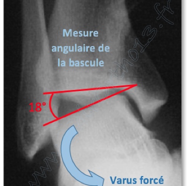 varus forcé cheville : radiographie