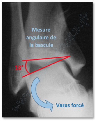 varus forcé cheville : radiographie