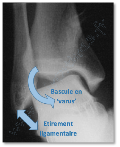 Définition, symptômes et diagnostic de l'entorse de cheville