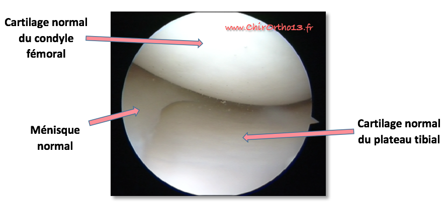 Arthroscopie, ménisques et cartilage : Informations et FAQ | Dr ...